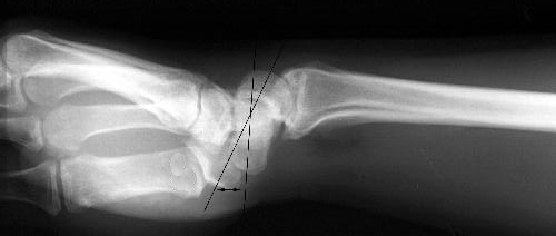 Nail infection is often due to fungal infection and develops along the edge of the fingernail or toenail is called a paronychia. Lunotriquetral Ligament Injury & VISI - Hand - Orthobullets